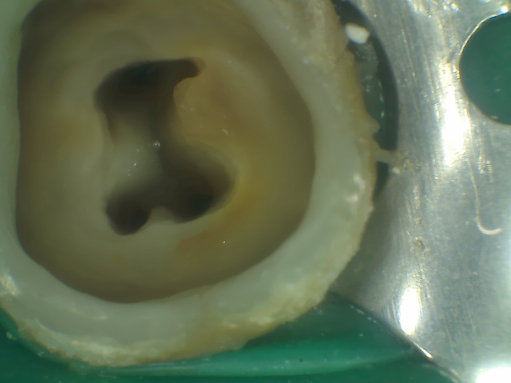 Parodontită apicală cronică rezolvată in 2 sedințe