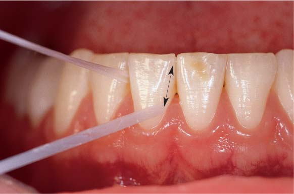 Banda dentară curățând spațiile interproximale