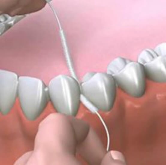 Ața dentară expandabilă sau Superfloss