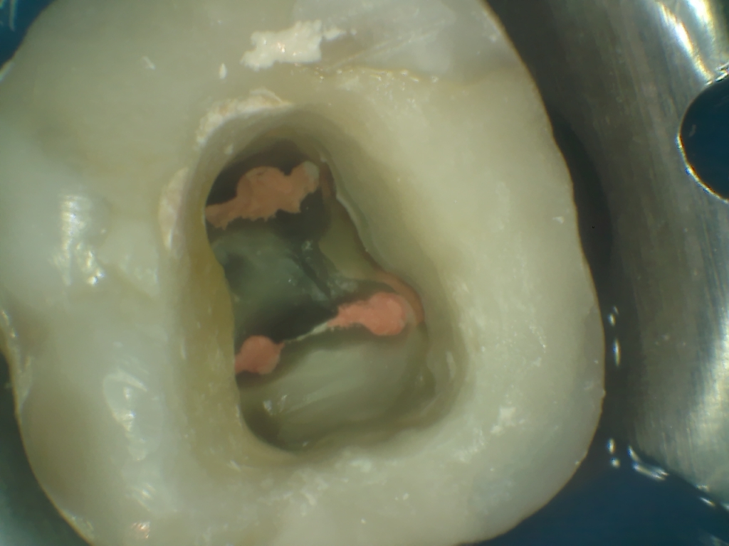 Tratament de canal la un molar cu 5 canale radiculare